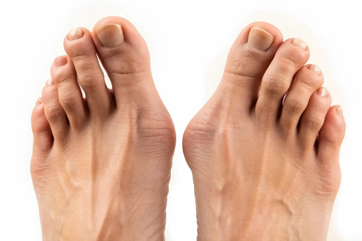 Hallux valgus är en progressiv deformitet